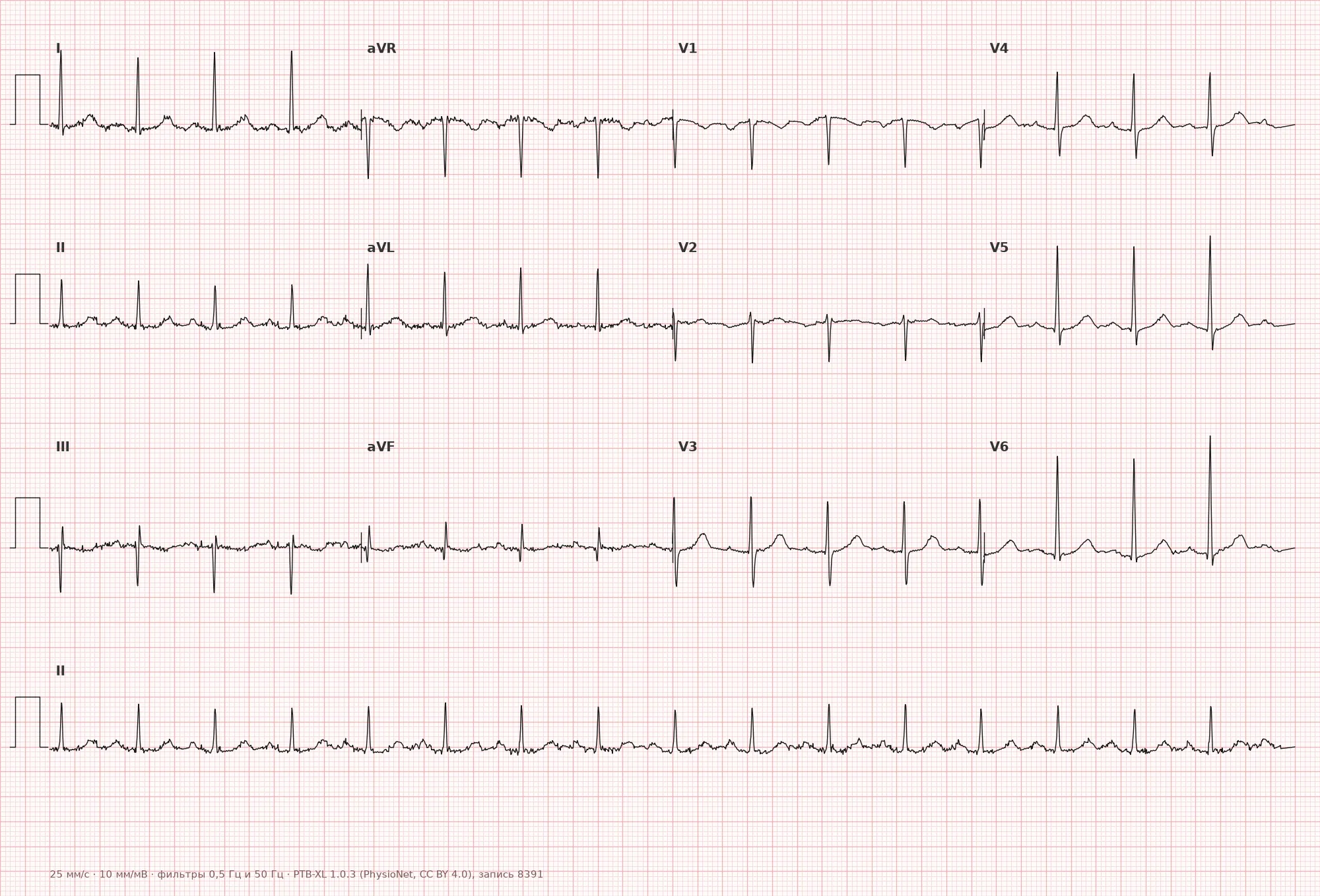 High QRS voltage on ECG — Example 1, 12-lead