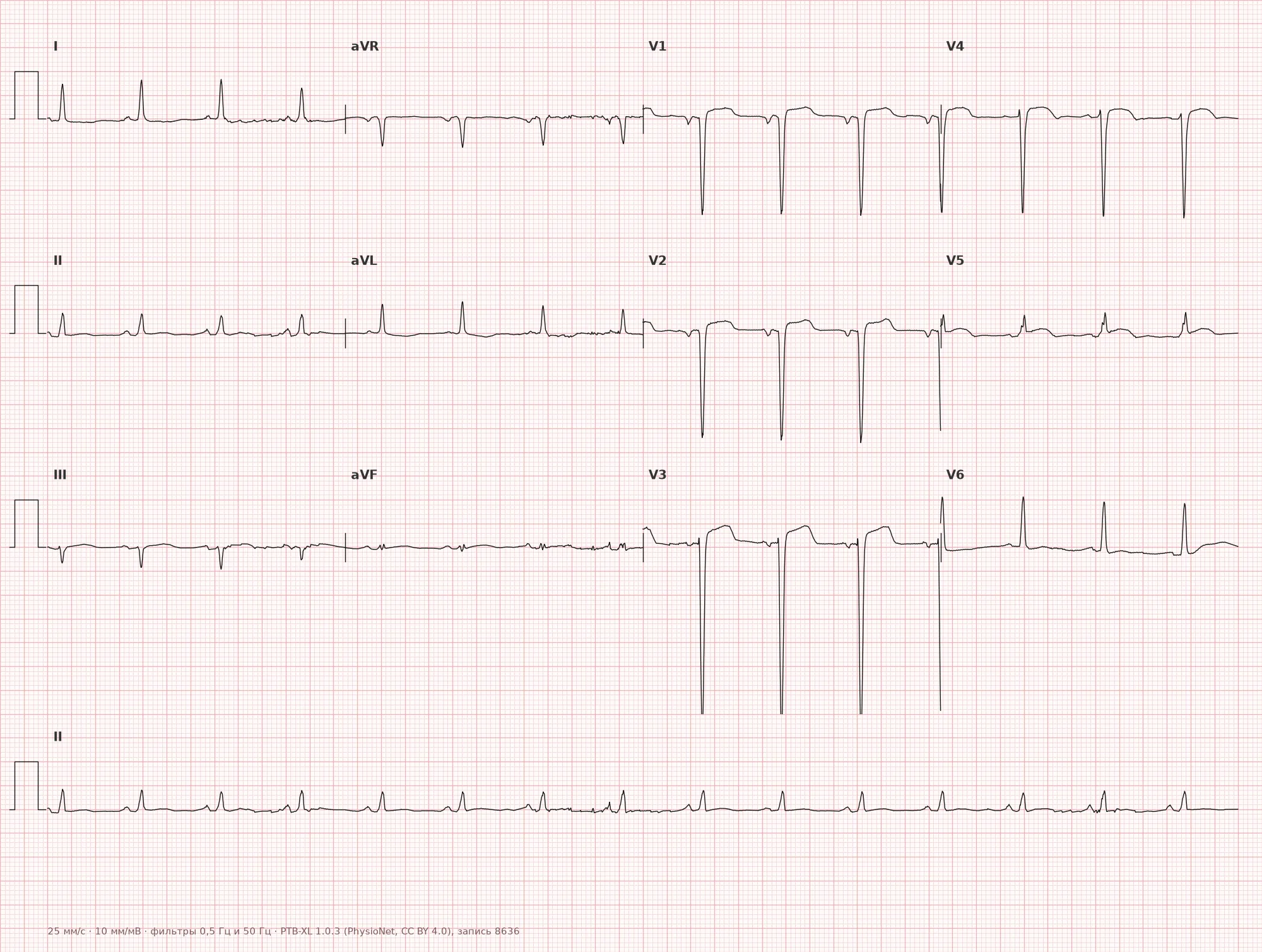 Left ventricular aneurysm on ECG — Example 1, 12-lead