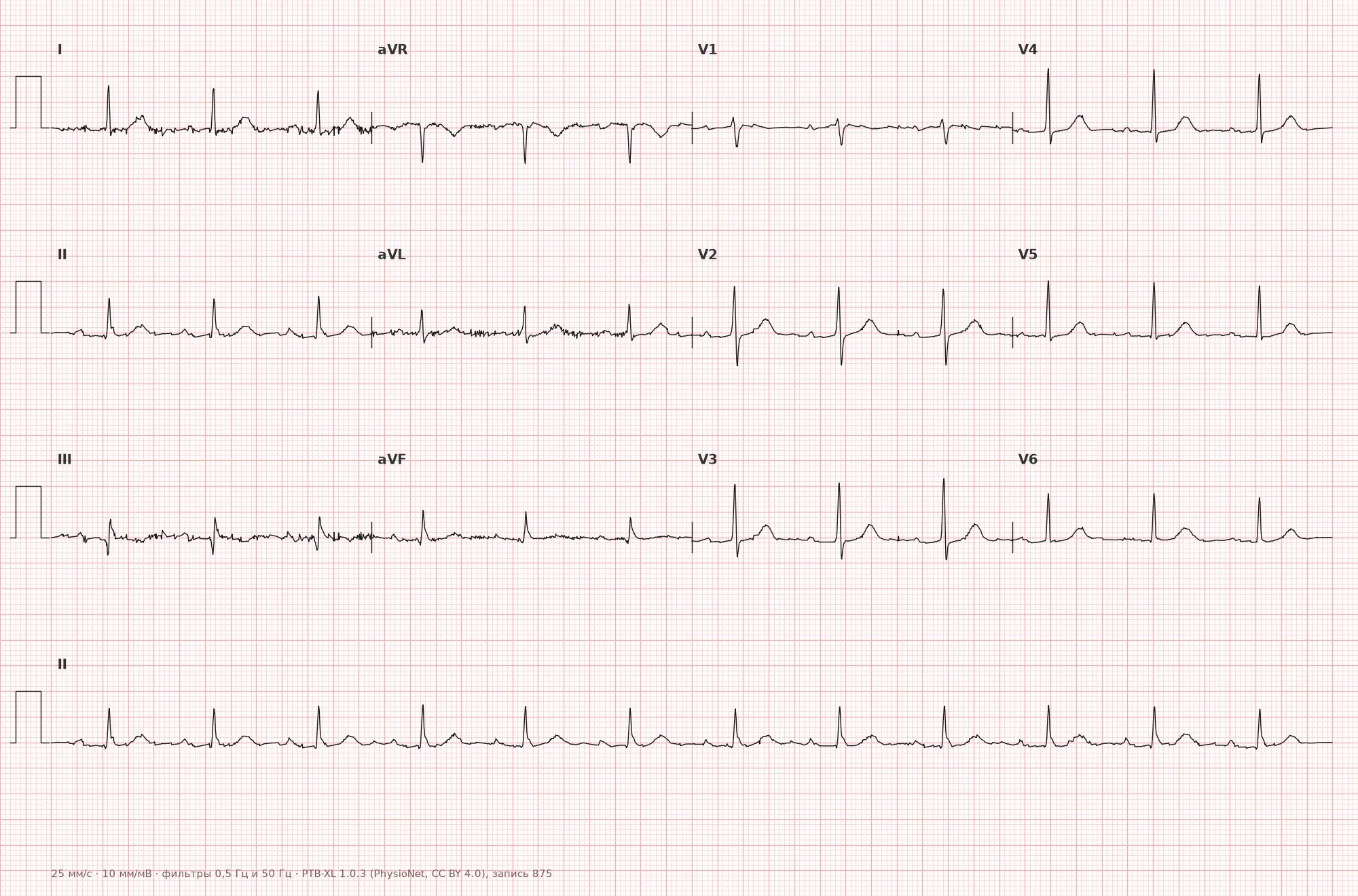 PQ (PR) interval on ECG — example 1, 12-lead